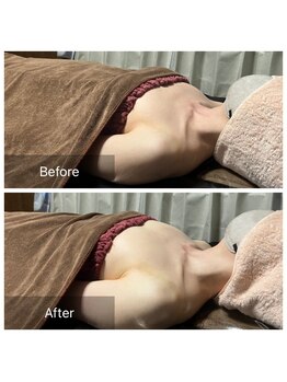 リノレア(LinoLea)/バストアップBefore after