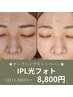 ★驚愕の美肌体験★ プラズマパールリフト☆光フォト　11000円→8800円