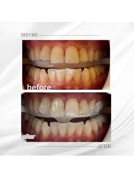 ホワイトニングセンター 大阪羽曳野店/歯科提携ホワイトニング症例