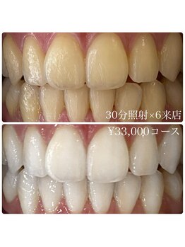 ホワイトニングルーム 横浜店(Whitening Room)/ホワイトニング/横浜
