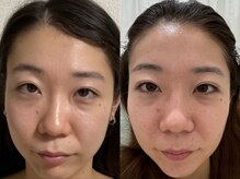 ビューティーベリッシモ(Beauty Bellissimo)/【眉形成でこんなに変わった】