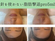 ソルニスデュオ(Solnis.-duo-)/小顔/酵素浴/ハイパーナイフEX2