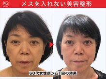 顔ジム 麻布店/60代女性顔ジム1回の効果