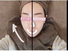 プレッシュ(Presh)/【小顔矯正】