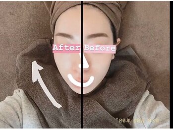 プレッシュ(Presh)/【小顔矯正】