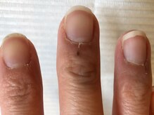 ネイルサロンアンドスクール シーグリーン(SEAGREEN)/【お悩み事例】爪周りのささくれ