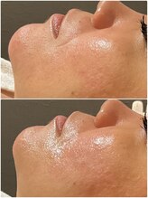 桜/即日☆小顔宣言♪