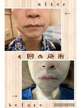 プルメリア/光脱毛メンズ