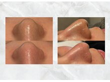 ロイズ(LOYS)/毛穴洗浄