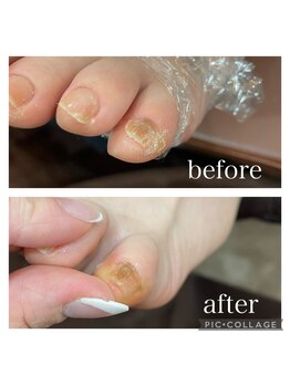 ゾゾ イリプレッセブル(ZOZO irreplaceable)/巻き爪補正の施術例