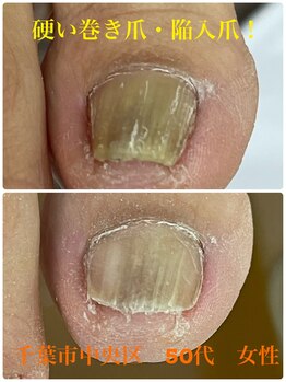 巻き爪じゅん 千葉駅前店/硬い巻き爪・陥入爪も1回で!