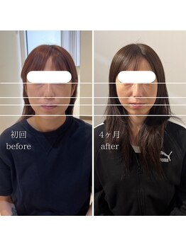 トイ鍼灸接骨院(TOY鍼灸接骨院)/●美容鍼