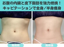 ナナ 銀座(Nana)/お腹の内臓・皮下脂肪を強力燃焼