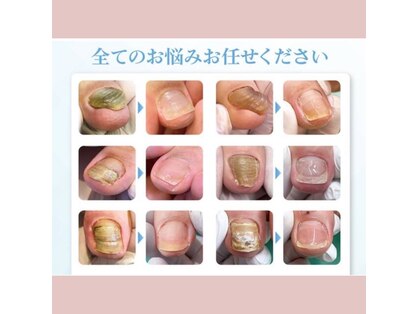 巻き爪補正店 大阪なんば店の写真