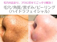 オリエンタルローザ 表参道(Oriental Rosa)/鼻周りの汚れハイドラ毛穴洗浄◎