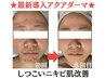 【20代ニキビ肌専用】繰り返すしつこいニキビを真皮深層から根本ケア★