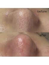 シューティングハーツ(SHOOTING HEARTS)/毛穴ケア（30代女性）