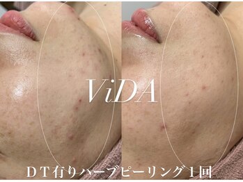 ヴィーダ 渋谷松濤(ViDA)/REVI DT有りハーブピーリング