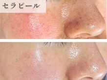 南青山コスメクリニック スキンラボ 横浜(SKIN LAB)/セラピール