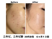 ラナン パラフューズ(Ranun's PARAFUSE.)の雰囲気（REVIハーブピーリングで繰り返さない肌質へ☆仙台ニキビケア）