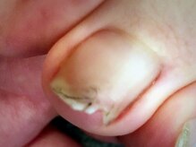 ネイルサロンアンドスクール シーグリーン(SEAGREEN)/【お悩み事例】足爪が縦割れする