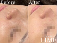 ライム 池袋東口(LIME)/ハーブピーリング｜毛穴洗浄