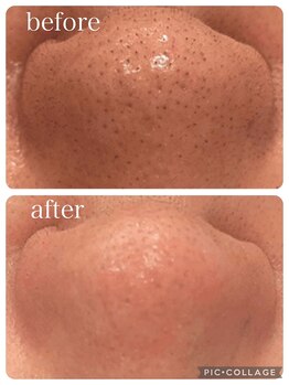 ランソ ビューティー 成田(RUNSO Beauty)/毛穴のお悩みスッキリ解決！