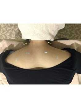 鍼灸施術を受けたい