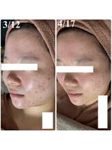 アルムダアクア 天王寺店(Aleumda AQUA)/ハーブピーリング/大阪/天王寺