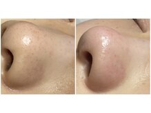 トータルビューティーサロン 凛/頑固な毛穴汚れもお任せ