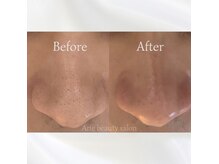 アリー(Arie)の雰囲気（ハイドラ毛穴洗浄）