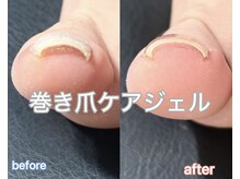 リノ(Lino)の雰囲気(【巻き爪ケアジェル】巻き爪による痛み軽減◎)