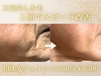 リアンの写真/美容サロンでできるのは希少なBBL！シミしわケアで、たるみやほうれい線にも嬉しい変化を◎