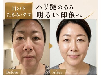 サロンチオリ 烏丸(Salon Chiori)の写真/目の下たるみ・クマで老けて疲れて見える大人女性へ。目元だけでなく、顔全体を引き上げる小顔矯正