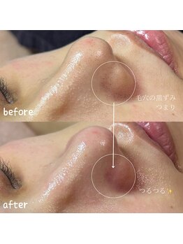 スピカ(Spica)/二刀流毛穴エクストラクション