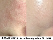 ベリンダ(BELINDA)/【最短・最速】艶玉肌