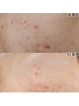 ヴェルシック(Belchic)/自信を持てる褒められる肌へ変化