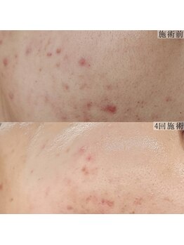 ヴェルシック(Belchic)/自信を持てる褒められる肌へ変化