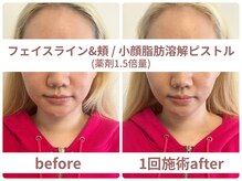 サボラミ(sabor A Mi)/フェイスライン小顔溶解ピストル