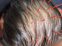 カラー(Calla)/育毛促進鍼♪