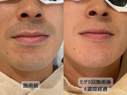 みんなのLED脱毛の写真