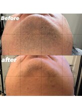 メンズエムボーテ 太田店(Men's M BEAUTE33)/【ヒゲ脱毛】経過