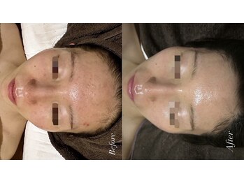 肌質改善専門【Salon da Mahina】毛穴ケア/ニキビケア/ハーブピーリング/ニキビ/ハーブピーリング/藤沢