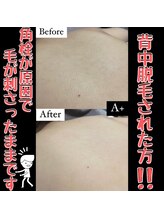 エープラス(A+) 背中の毛 角栓角質