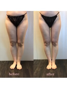 ラウレア 松山店(LAULEA)/ハイパーナイフ痩身before/after