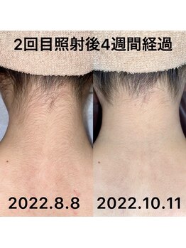 ビーモア(be MoA)/うなじスッキリ魅力アップ！