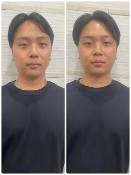 長寿鍼灸院 長寿整骨院/men's美容鍼50本効果★