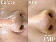 ライム 池袋東口(LIME)/ハーブピーリング｜毛穴洗浄