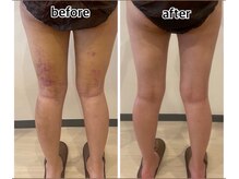 インディバジェム(GEM)/ビフォーアフター