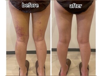 インディバジェム(GEM)/ビフォーアフター